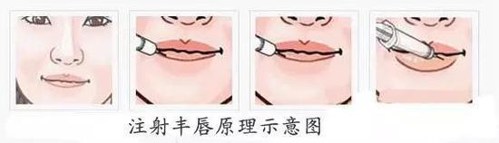 玻尿酸注射丰唇