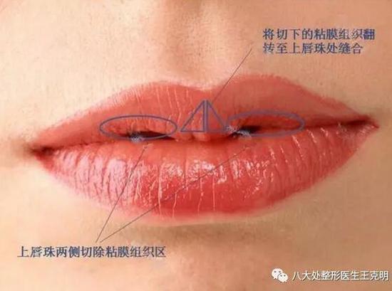 唇部整形手术