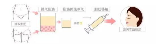 自体脂肪丰唇珠
