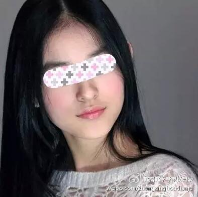 鼻尖过大、过低