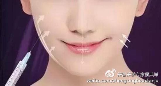 瘦脸针