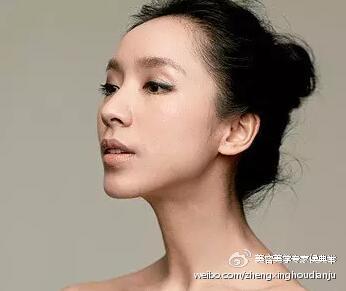 鼻综合整形