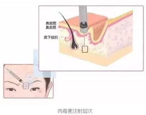 肉毒素注射层次