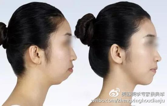 缺下巴