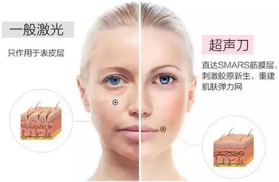 超声刀