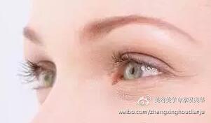 双眼皮