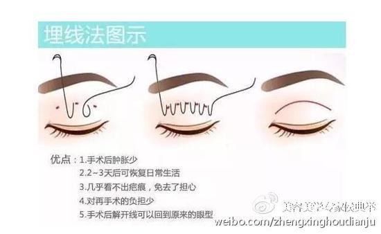 埋线双眼皮