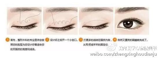 埋线双眼皮