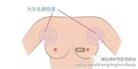 额外的乳房