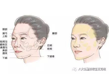 自体脂肪面部填充