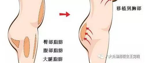 自体脂肪填充