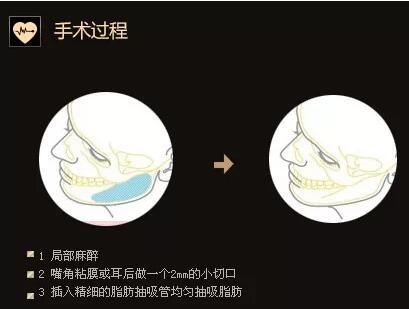 注射瘦脸