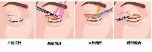 双眼皮切口矫正