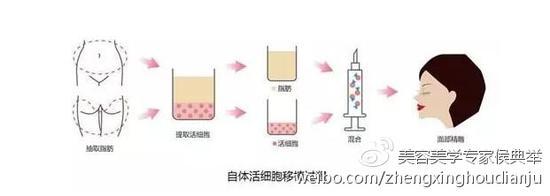 自体脂肪填充