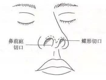 鼻综合整形