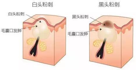 黑头的成因