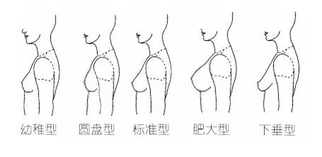胸型划分
