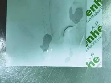 断针被成功取出