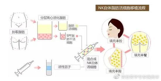 自体脂肪除皱