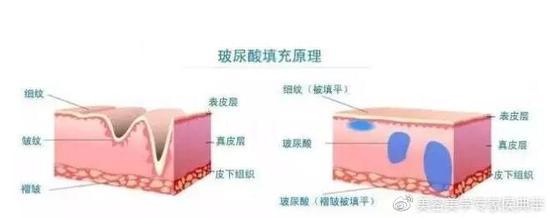 玻尿酸除皱