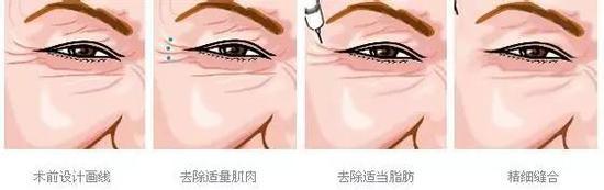 肉毒素