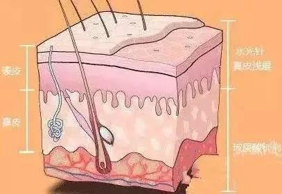 水光针