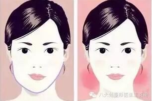 面部不对称