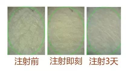 无针水光