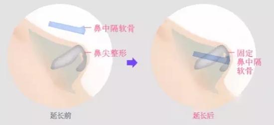 鼻中隔软骨