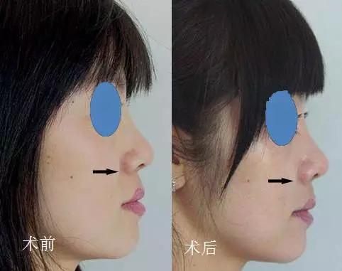 鼻基底整形效果