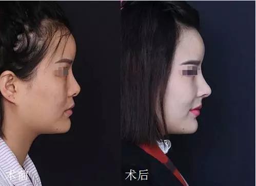 鼻基底整形效果