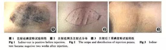 肉毒素治疗多汗症