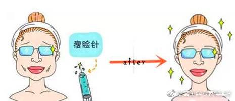 瘦脸针