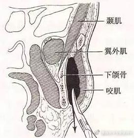 瘦脸针