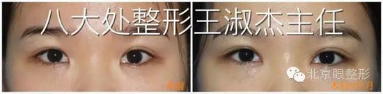 开内眼角案例