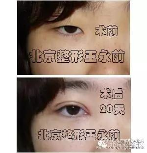 双眼皮+开眼角案例