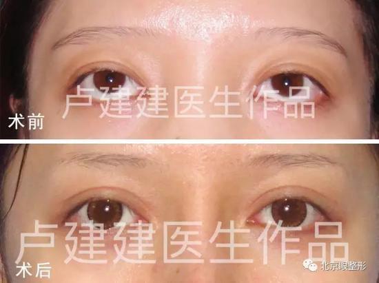 双眼皮案例