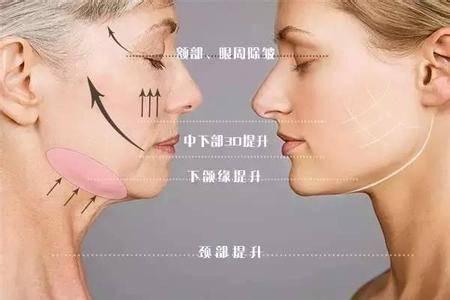 线雕