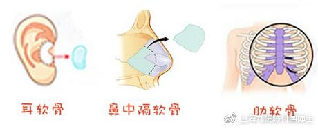 软骨隆鼻