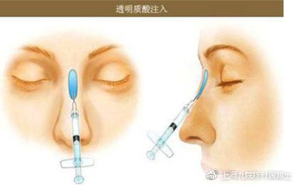 玻尿酸隆鼻