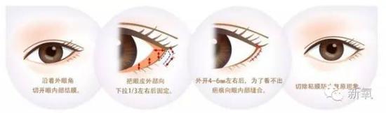 外眼角的加长