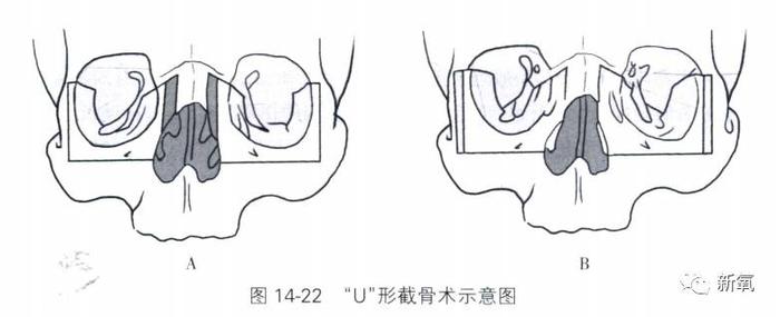 “U”型截骨术