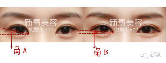 眼睑的下至