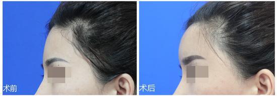 丰太阳穴