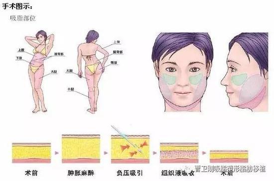 手术图示