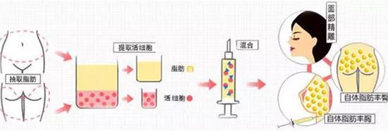 自体脂肪移植