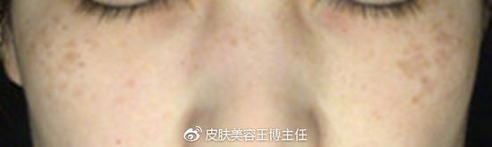 褐青色痣