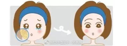 脂肪移植