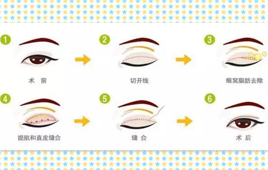 吸脂