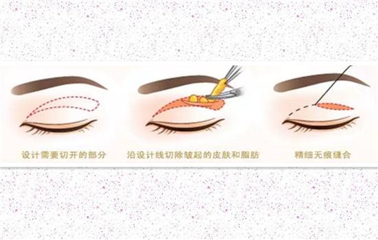 眼轮匝肌肥厚